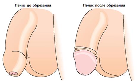 пенис до и после обрезания