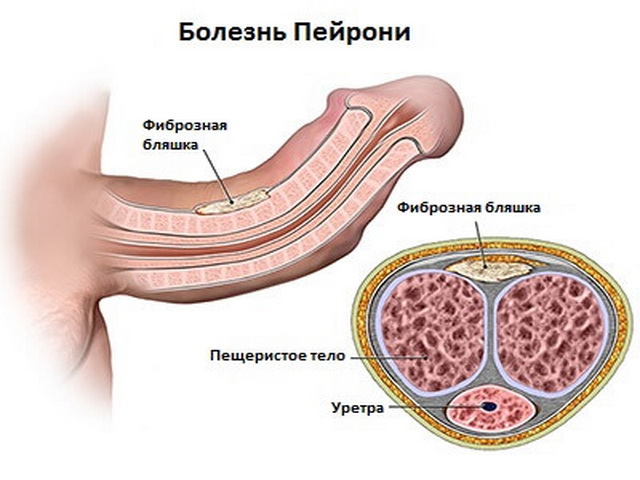 фиброзная бляшка при болезни Пейрони