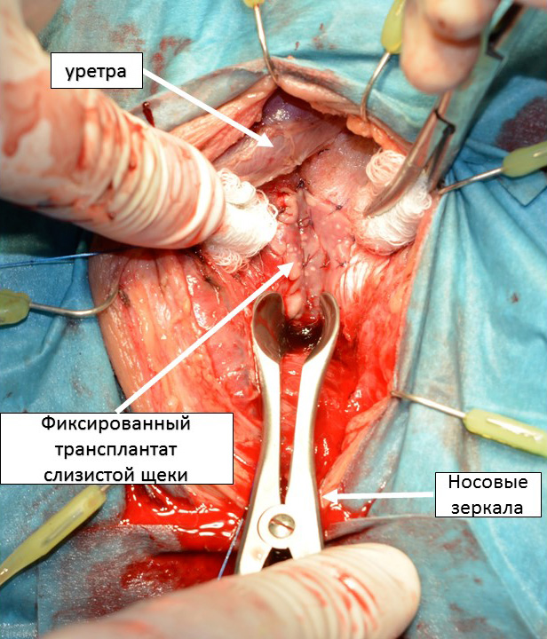 Буккальная пластика луковичного отдела уретры - лечение стриктуры уретры